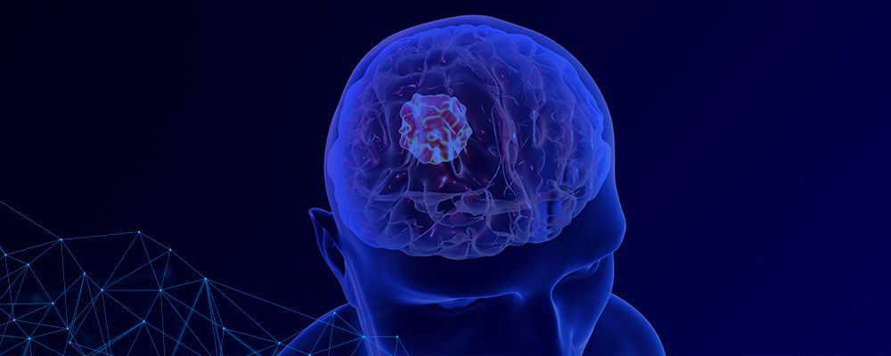 É possível viver bem após um tumor cerebral? Saiba todos os tipos, sintomas e tratamentos
