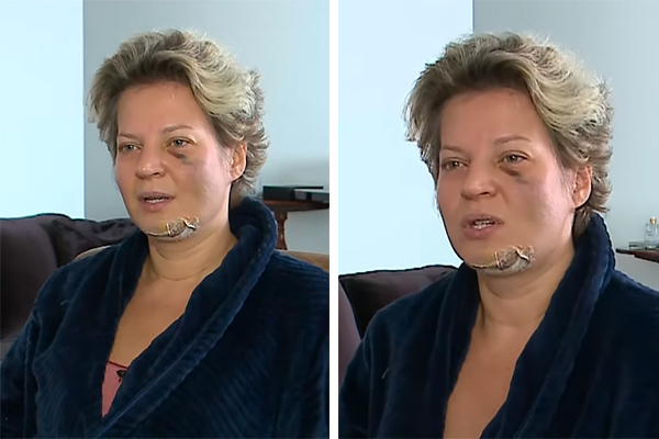 VÍDEO: Deputada Joice Hasselmann aparece com machucados no corpo e diz que sofreu atentado