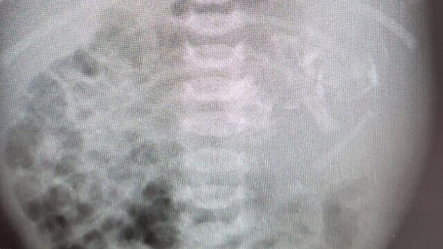 Bebê nasce com embrião de gêmea dentro da barriga