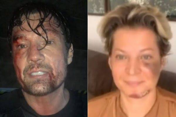 Ex-ator da Globo aparece ferido e debocha de Joice Hasselmann: “Sofri um atentado”