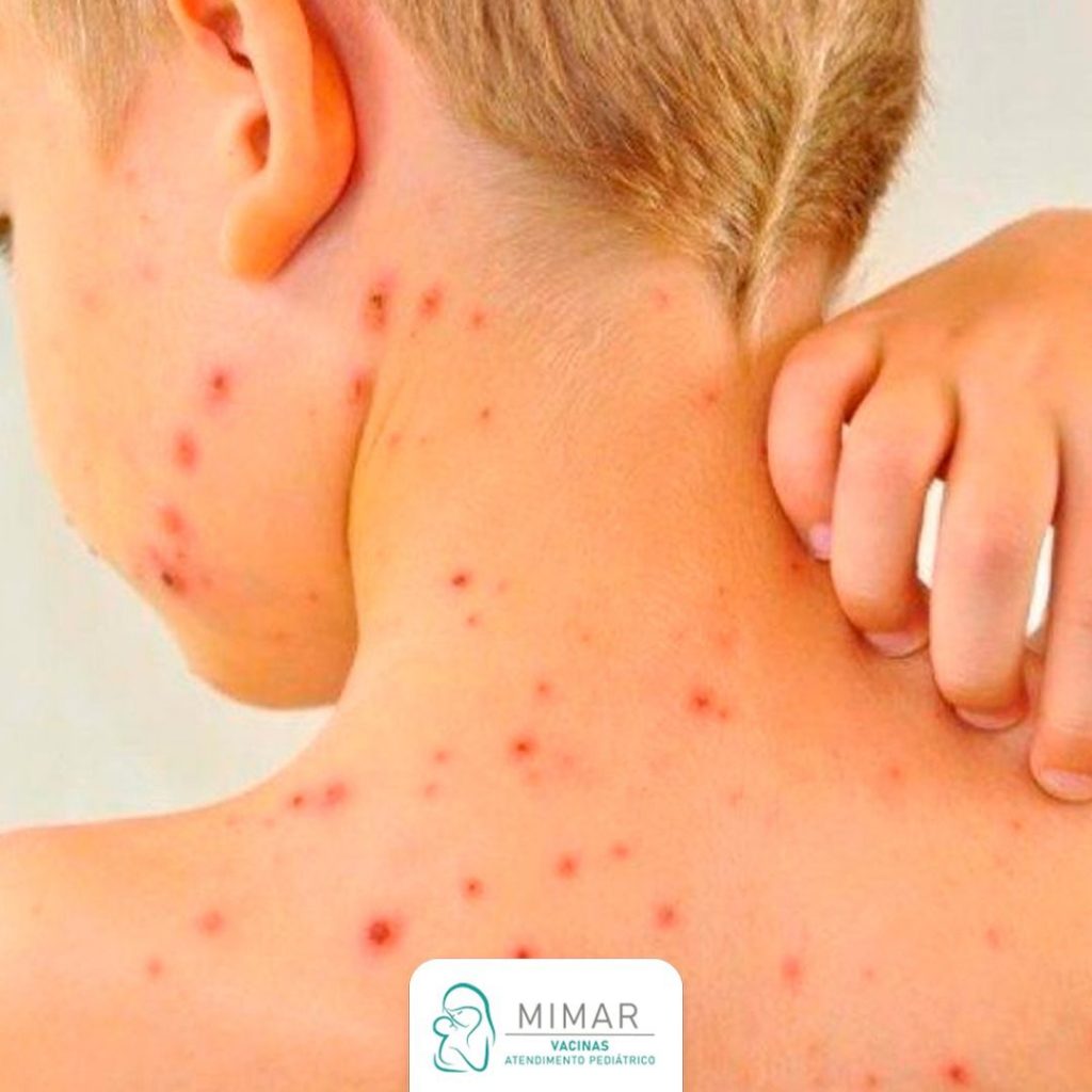Pediatras alertam: Sarampo avança no País por falta de vacinação