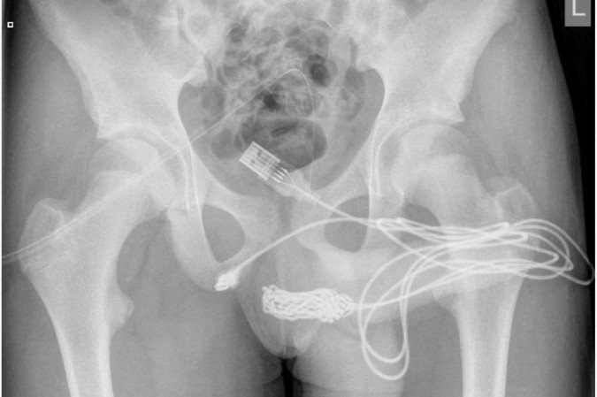 FOTOS: Adolescente de 15 anos é operado após inserir cabo USB no pênis