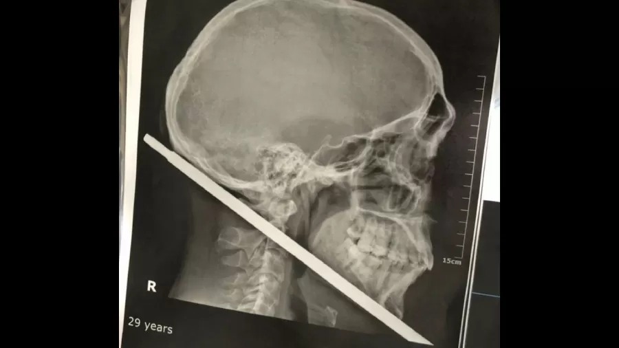 Homem sobrevive após ferro de arma caseira atravessar pescoço: 'Milagre'