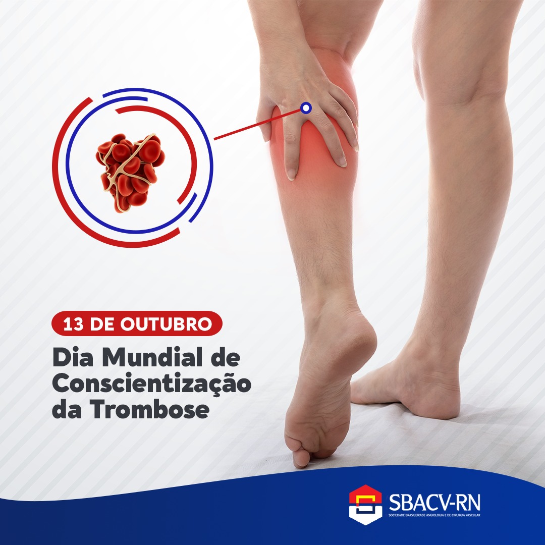 Trombose: saiba o que é, os principais sintomas e como prevenir