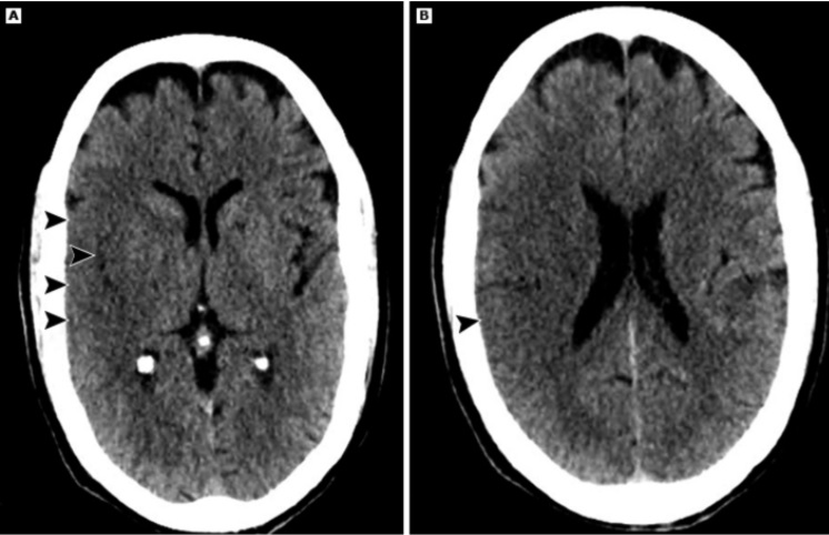 AVC provoca a morte de cerca de 1,9 milhão de neurônios por minuto; veja quais são os sintomas