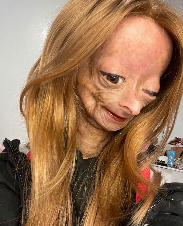 Youtuber com transtorno de envelhecimento morre aos 15 anos