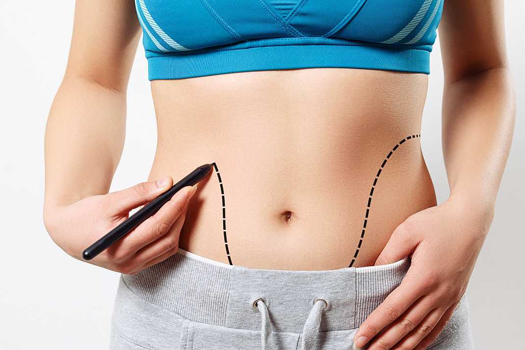 Confira 5 mitos e verdades da lipoaspiração fracionada, nova técnica capaz de eliminar 100% da gordura localizada