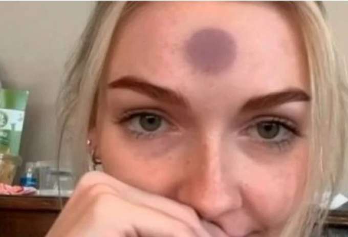 Influencer fica com hematoma após grudar “plug que suga ânus” na testa