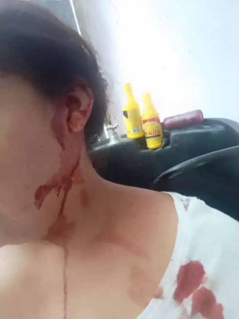 Mulher leva mordida na orelha após reclamar com vizinho de som alto