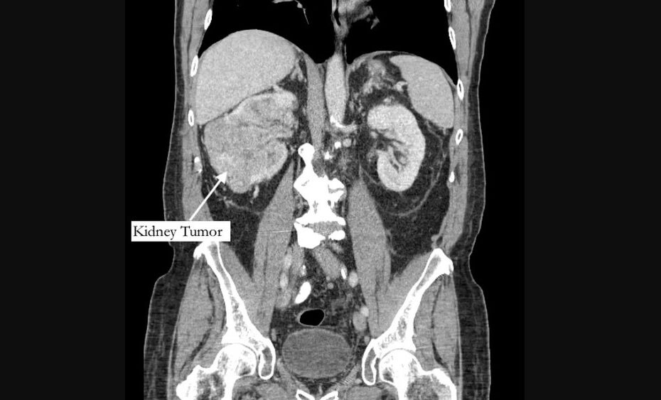 Homem vai tratar dor no dedão do pé e descobre tumor em fase terminal