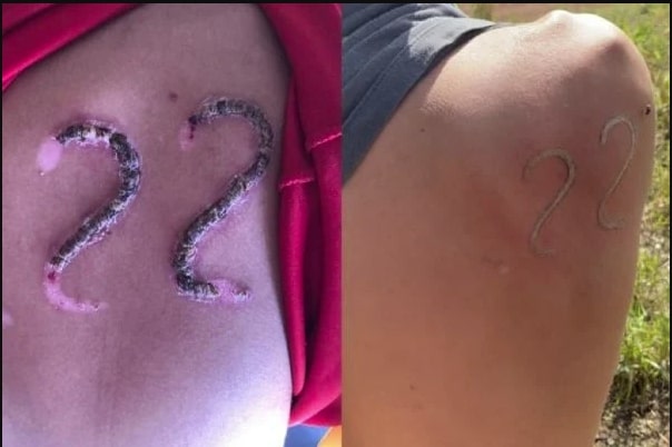 Adolescente é desafiado por amigos e marca 22 de Bolsonaro na pele com ferro em brasa