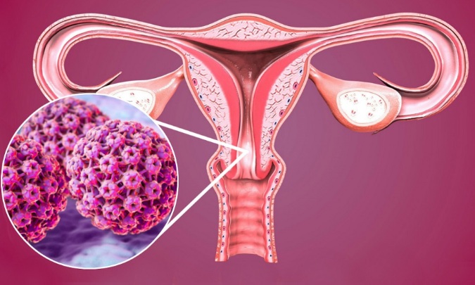 Câncer de colo de útero pode ser uma doença silenciosa; Conheça os sintomas e prevenção