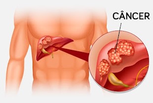Câncer no fígado: saiba quais são os primeiros sintomas