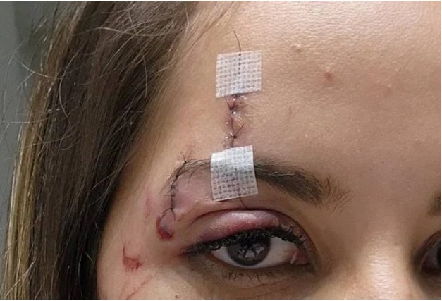 Mulher é atingida por drone durante show e precisa passar por cirurgia
