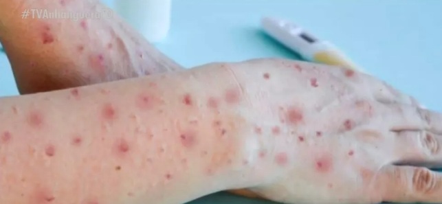 Prefeitura de SP confirma primeiros casos de varíola dos macacos em crianças
