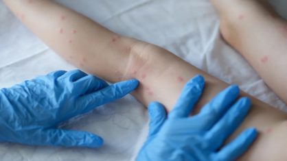 Criança de 11 anos é o primeiro caso confirmado de varíola dos macacos nessa faixa etária no RN