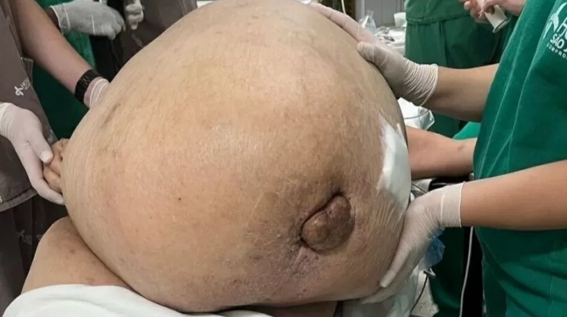 Mulher tem tumor de 46 kg retirado em cirurgia de emergência