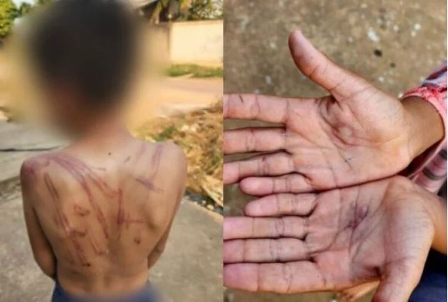 Mãe espanca e queima filho de 10 anos por causa de R$ 10