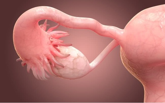 Câncer de ovário é uma doença é silenciosa; veja como descobrir