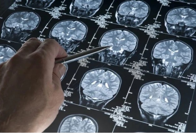 Alzheimer pode ser doença autoimune do cérebro, sugere pesquisador