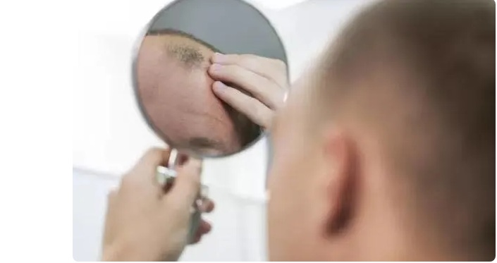 Calvície: Cientistas criam com sucesso técnica inédita que estimula o crescimento do cabelo