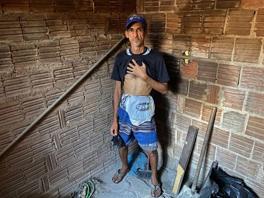 Por falta de bolsa de colostomia, paciente improvisa com sacola de supermercado: ‘Não aguento mais tanto sofrimento"