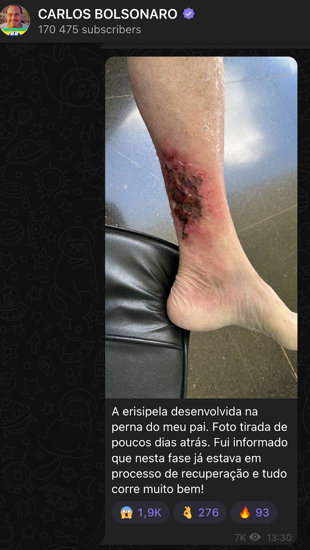 Filho posta foto da perna de Bolsonaro com erisipela; confira como ficou