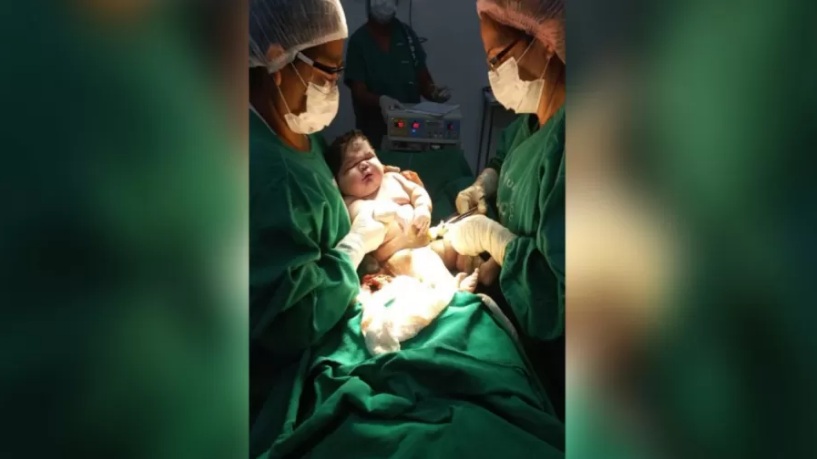 'Bebê gigante' nasce com 7 kg e bate recorde no Amazonas