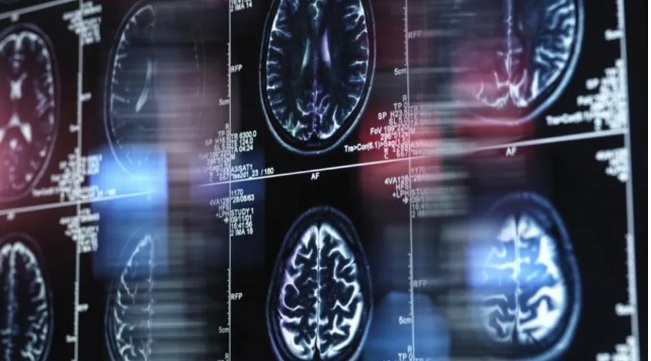 Chinês de 19 anos pode ser pessoa mais jovem com Alzheimer e causa é mistério para cientistas