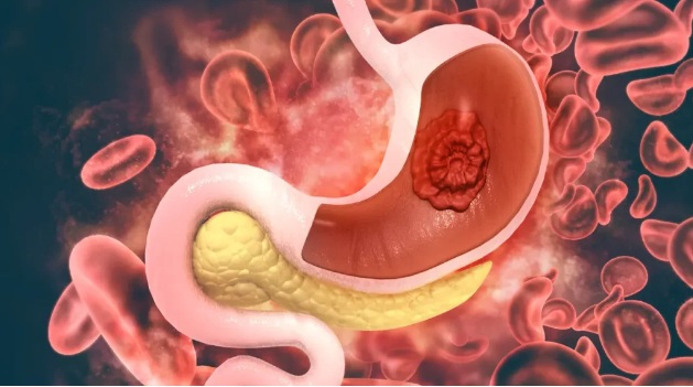 Conheça os alimentos que se deve evitar para reduzir risco de câncer do intestino