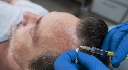 Gasto com transplante e implante de cabelo sobe 60% em um ano