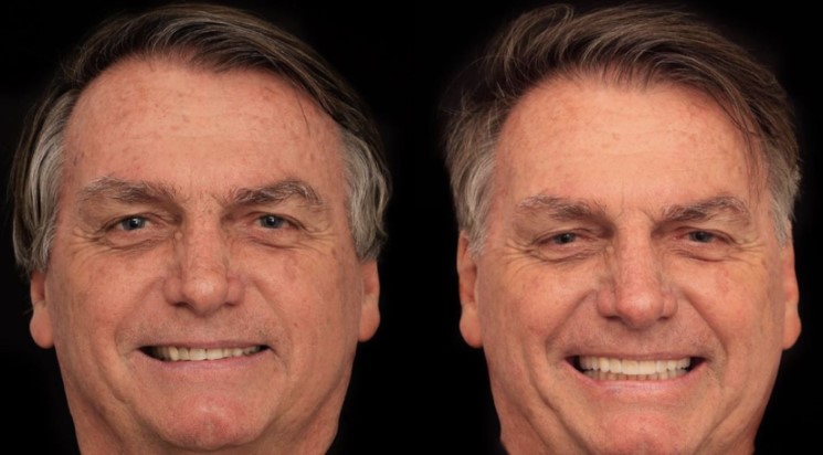 Bolsonaro faz harmonização orofacial em clínica de Goiânia; veja resultado