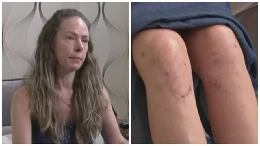 Mulher denuncia médico após cirurgia feita no joelho errado