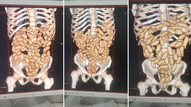 Raio X mostra cápsulas de cocaína no estômago de 6 passageiros em aeroporto de SP