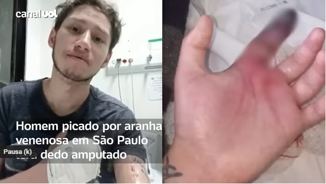 Homem é picado por aranha, terá que amputar dedo e denuncia médicos: "Não fizeram nada"