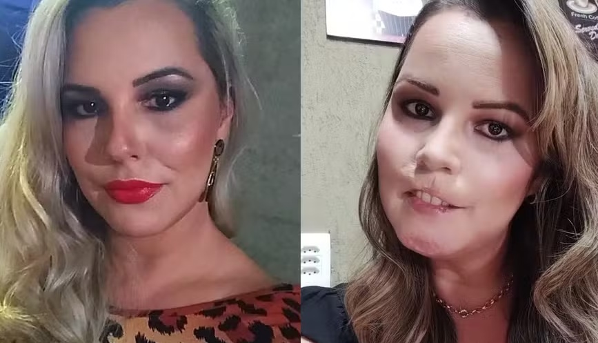 Mulher perde lábio superior após harmonização facial